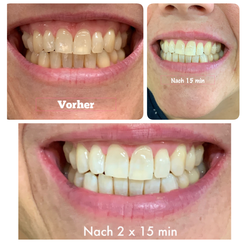Vergleich Zahnaufhellung Intensivbehandlung