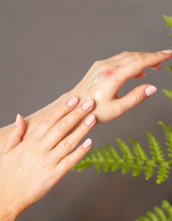 Hand mit gereizten Stellen